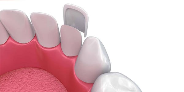 Dental Veneers Ottawa