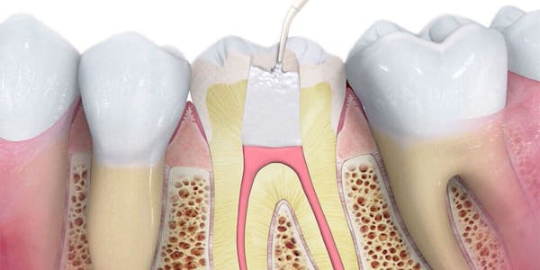Root Canal Treatment Ottawa