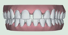 Image showing widely spaced teeth caused by abnormal jaw bone growth or missing teeth, potentially leading to spacing issues and periodontal diseases.