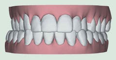 Illustration of crossbite, where upper and lower jaws are misaligned, resulting in one or more upper teeth biting on the inside of lower teeth, leading to tooth wear, gum disease, and bone loss.